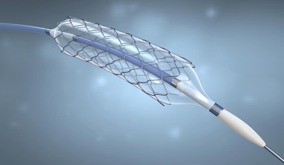 Qualitätsanalyse in der Medizintechnik - Untersuchung von Stents